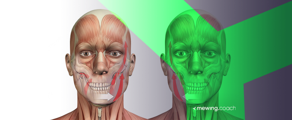 Lateral Jaw Deviation: Symptoms, Causes, and Treatment Options | Mewing ...