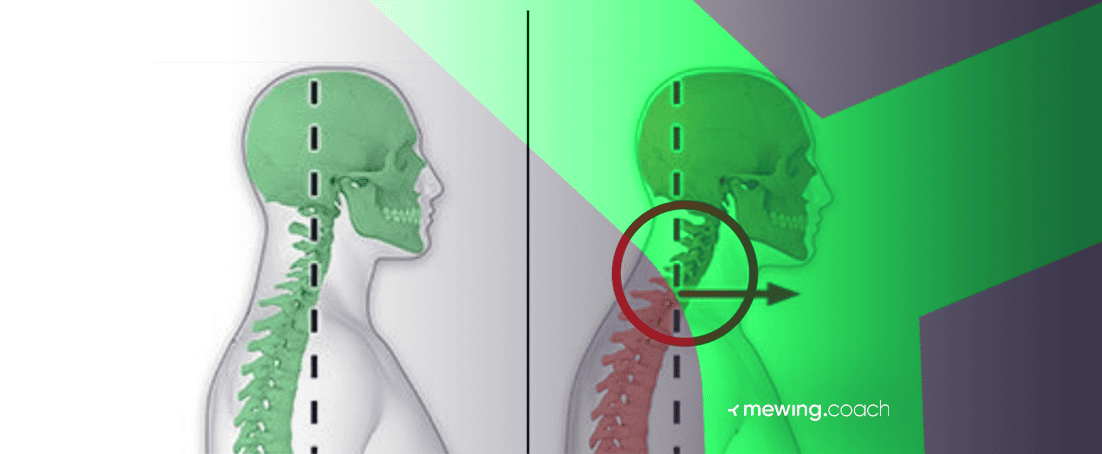 Mewing neck pain