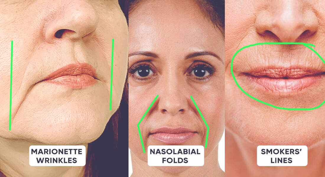 Differences between wrinkles: marionette lines vs nasolabial folds vs smokers' lines