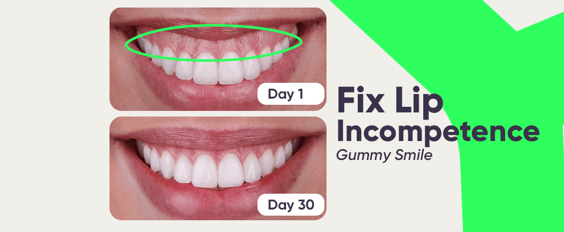 Lip incompetence vs gummy smile