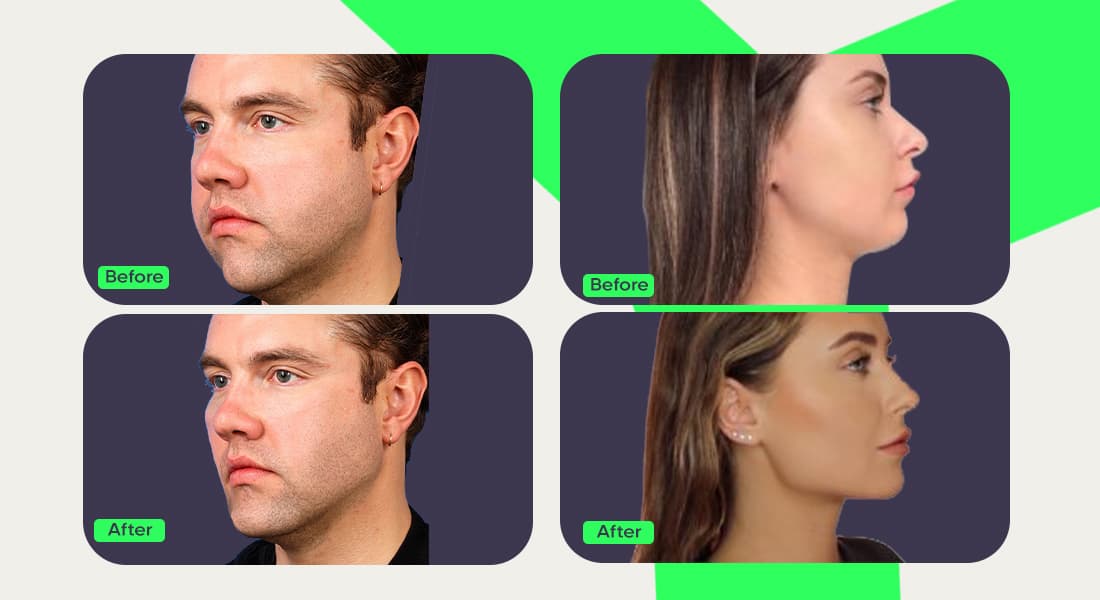 How to get a chiseled jawline Photo