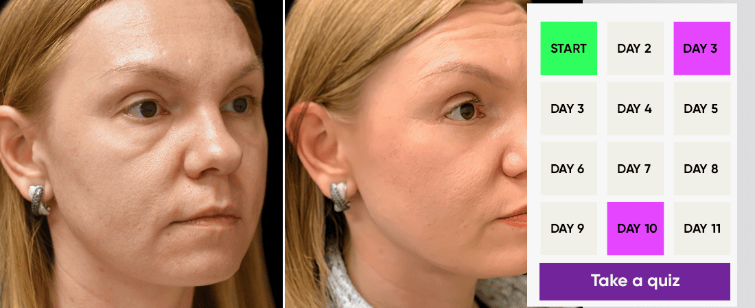 What can be done to reverse my malar bags: filler, RF, CO2, microneedling  or other? (photos)