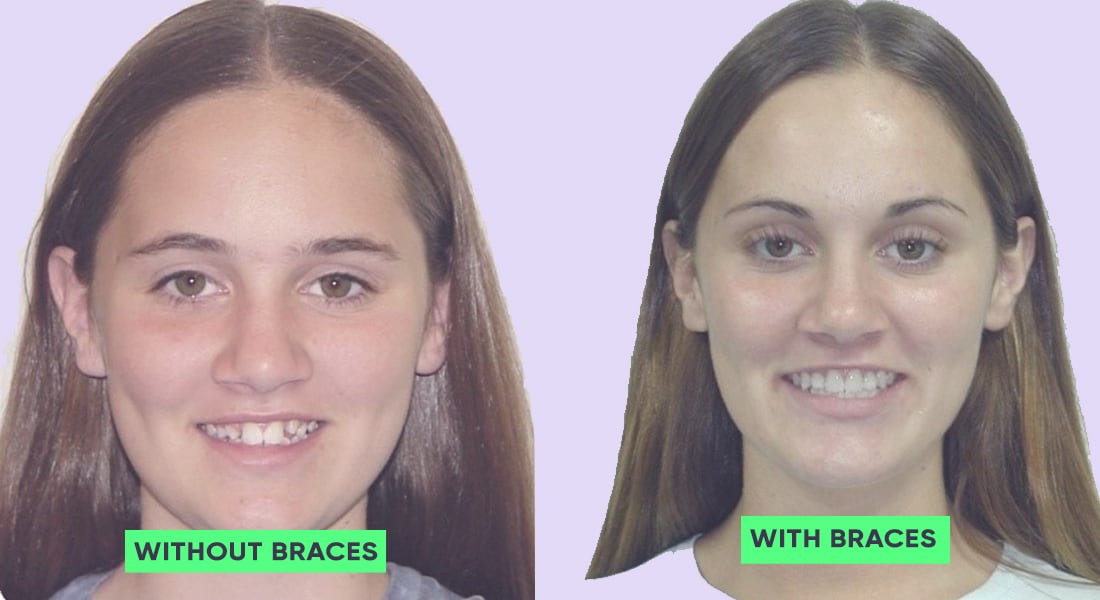Girl teeth before and after braces