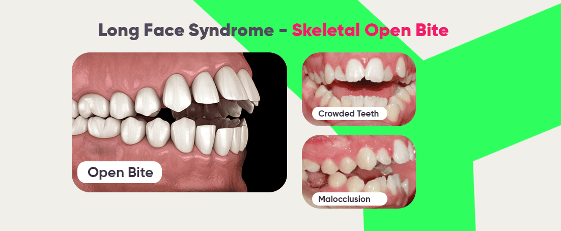 Long face syndrome: open bite, crowded teeth, malocclusion
