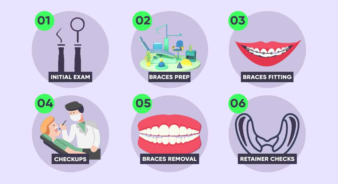 Step by step guide on braces: from applying to removing