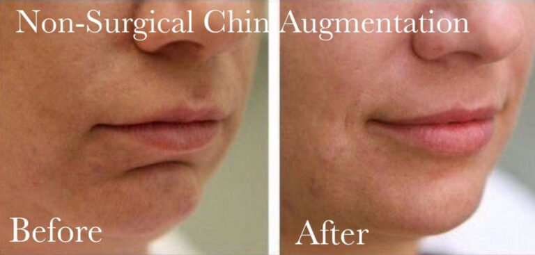 How to Get Rid of Mental Chin Crease Naturally | Mewing.coach