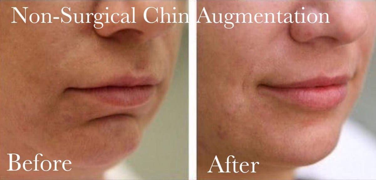 Mental chin crease filler before and after