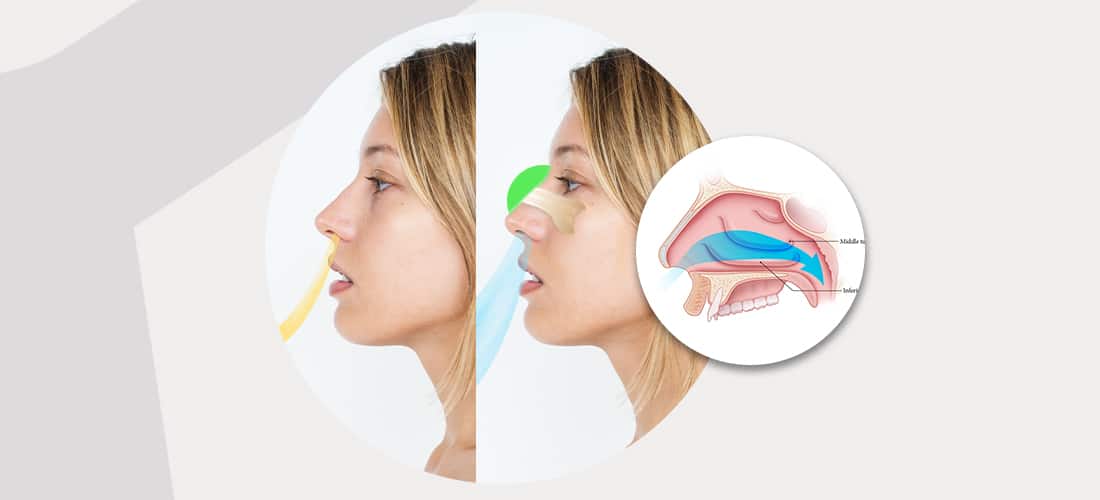 Nasal strips improve airflow
