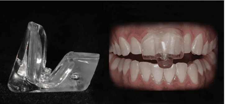 NTI occlusal guard splints