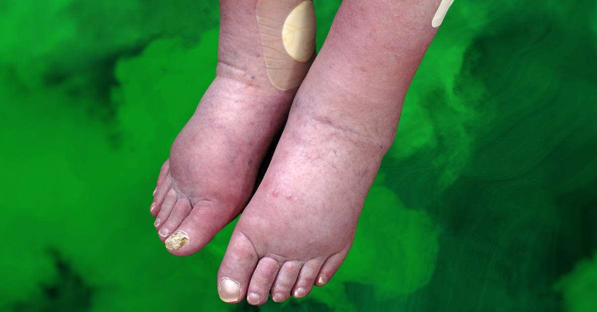 Examples of what causes swollen ankles in old age