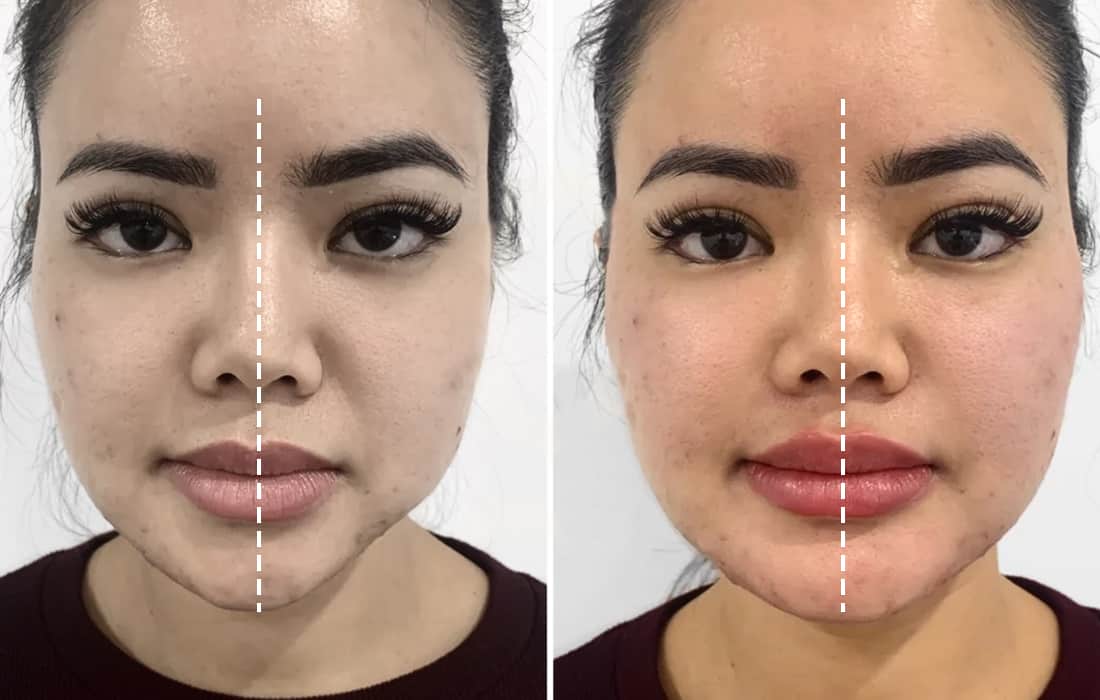 Face symmetry before and after mewing