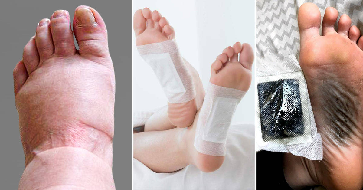 Foot patches help with swollen ankles in summer