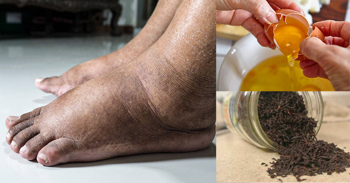Home remedies for swollen ankles in the elderly