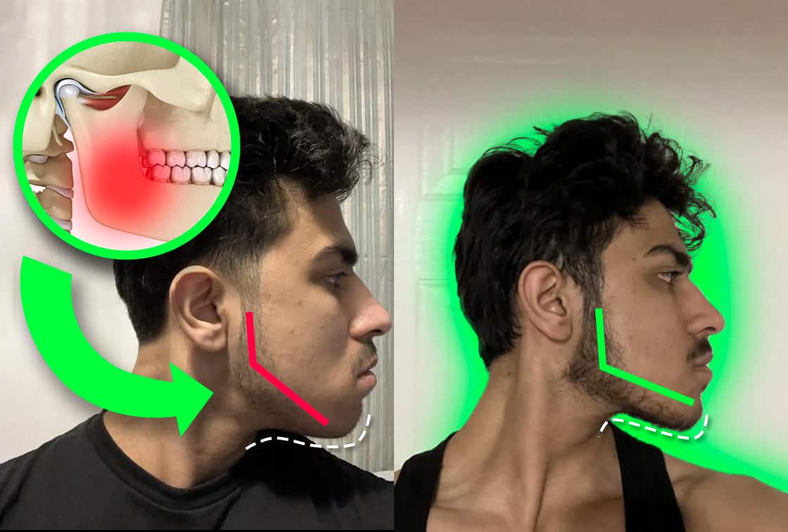 Jawline before and after mewing