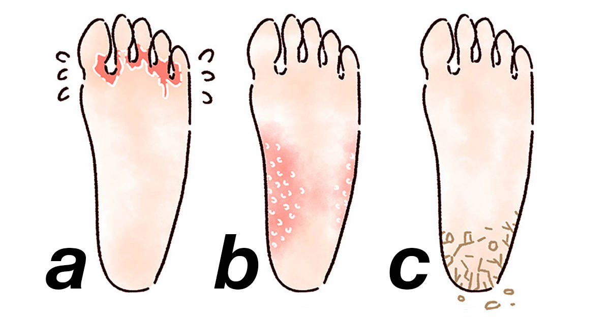 6 Home Remedies for Cracked Heels That Actually Work