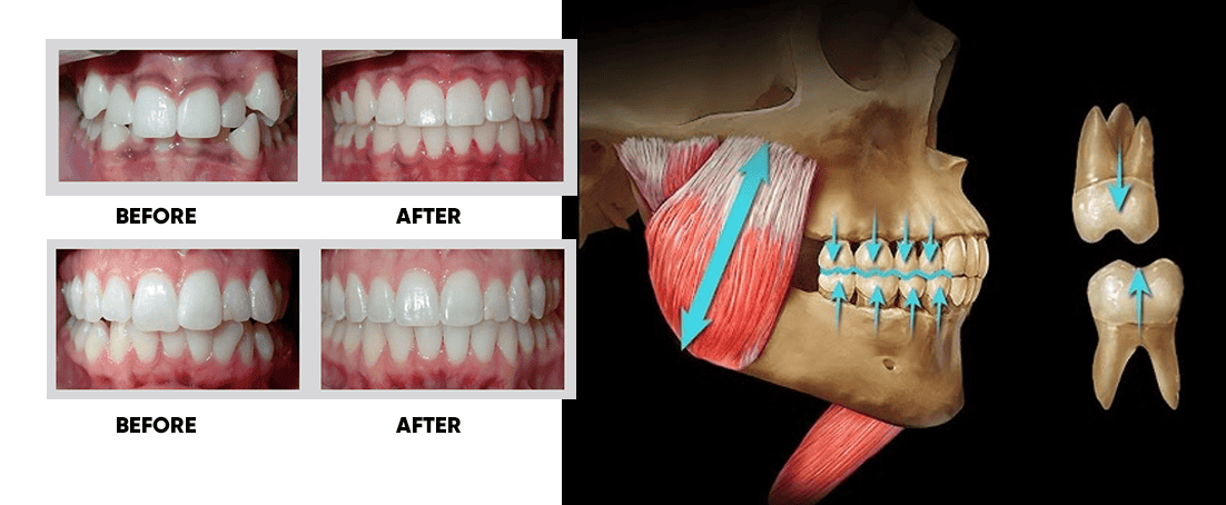 Teeth before and after mewing