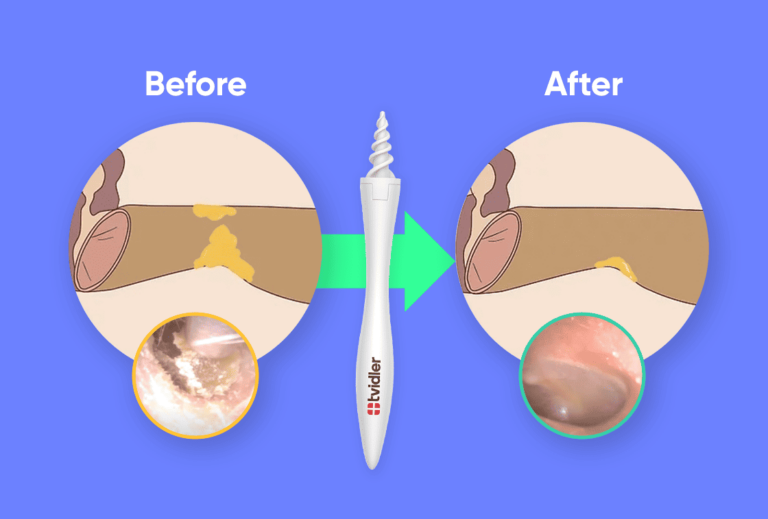 Can Impacted Earwax Cause Jaw Pain? Mewing.coach
