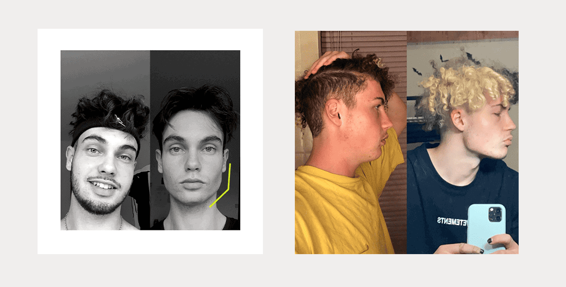Jawline sculpting before and after