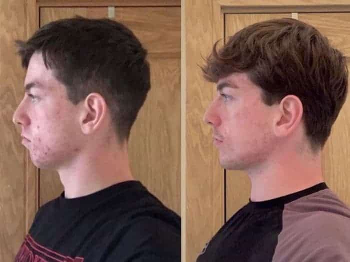 Before and after thumb pulling adult man