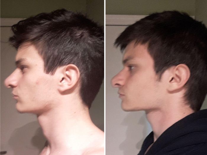 Surgery or mewing exercises. Result of a jawline reshape. Stock