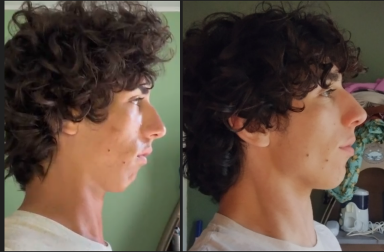 Beet mewing before and afters #fyp #mewing #jawline, Jawline