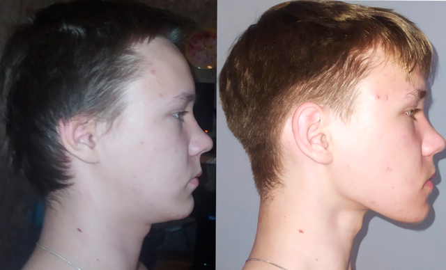 17M) 1 Year and 10 Month Mewing (No Chewing) (Same Weight) : r/Mewing