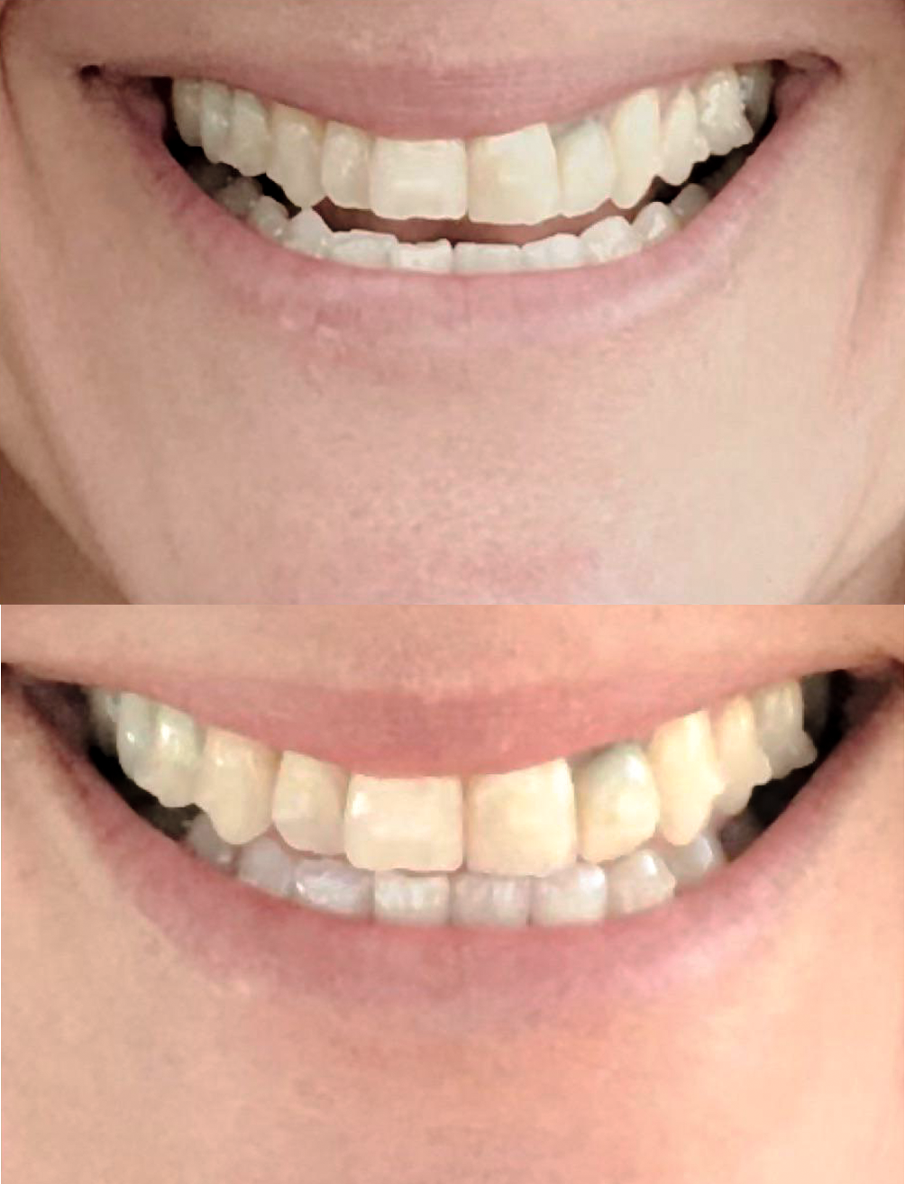 Crossbite before and after mewing