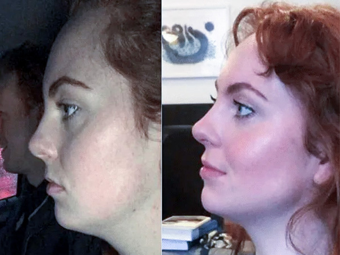 4 Months Mewing Before & After at Age 28 