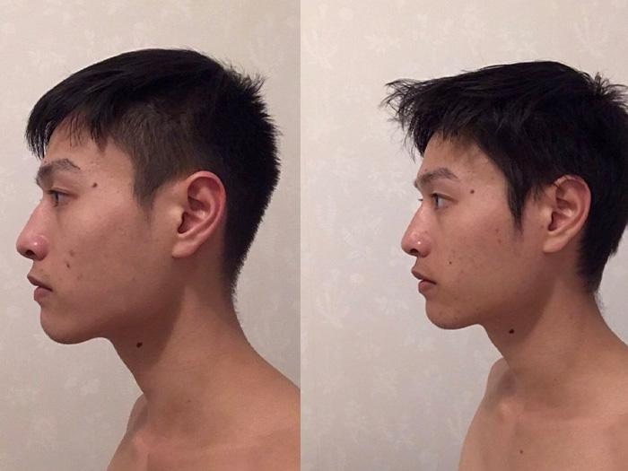 Beet mewing before and afters #fyp #mewing #jawline, Jawline