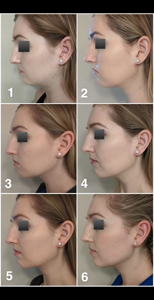 Face Pulling - Improve your facial appearance with mewing and headgear