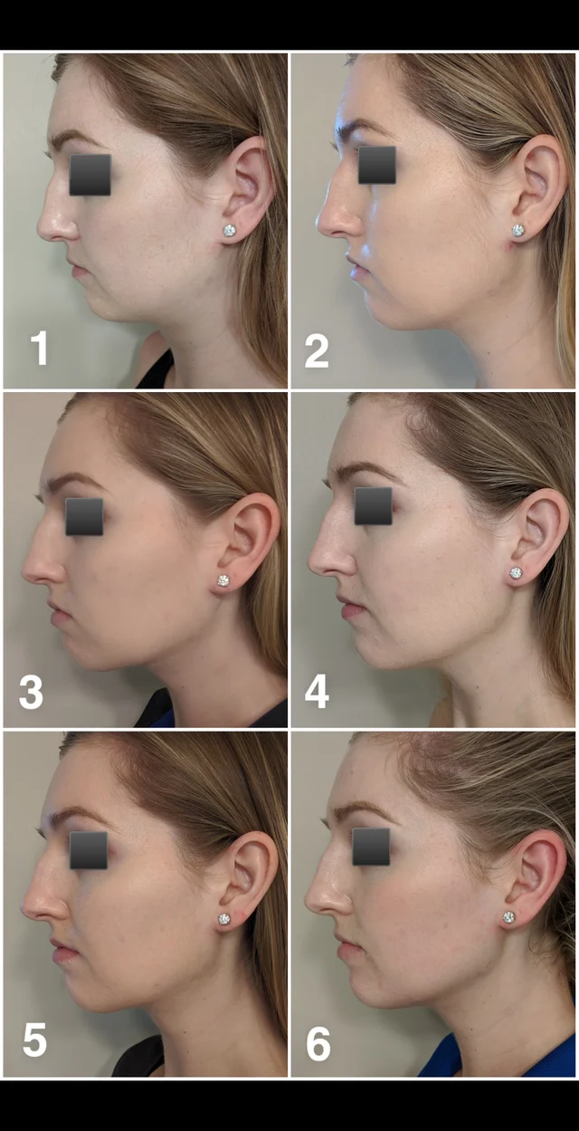 Mewing: Before and After the Jawline Defining Trick