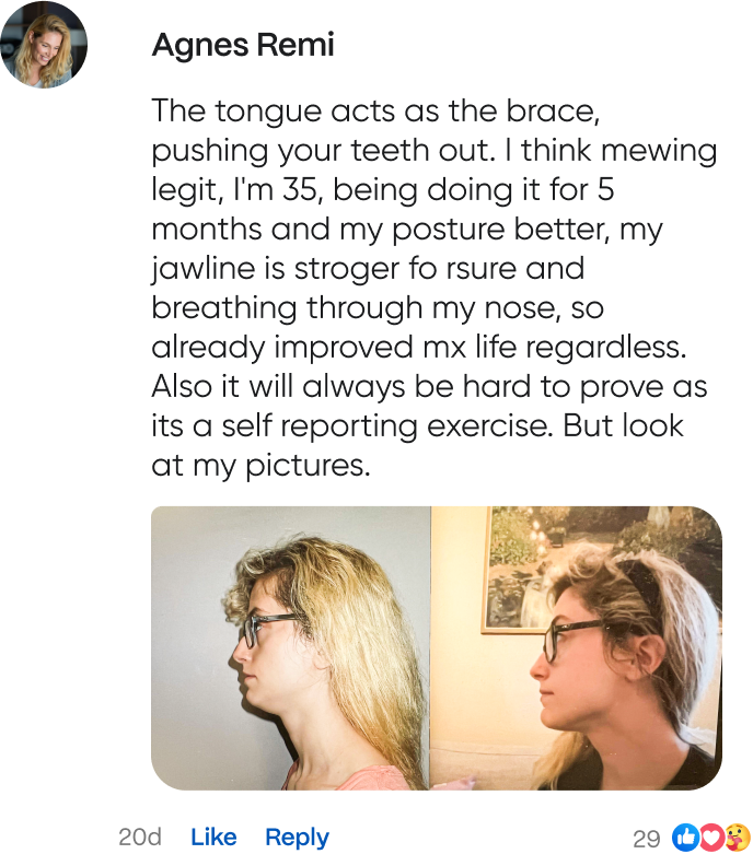 Agnes Remi review of mewing app: The tongue acts as the brace, pushing your teeth out. I think mewing is legit, I'm 35, been doing it for 5 months and my posture is better, my jawline is stronger for sure and breathing through my nose, so already improved my life regardless. Alsi it will always be hard to prove as it's a self reporting exercise. But look at my before and after pictures.